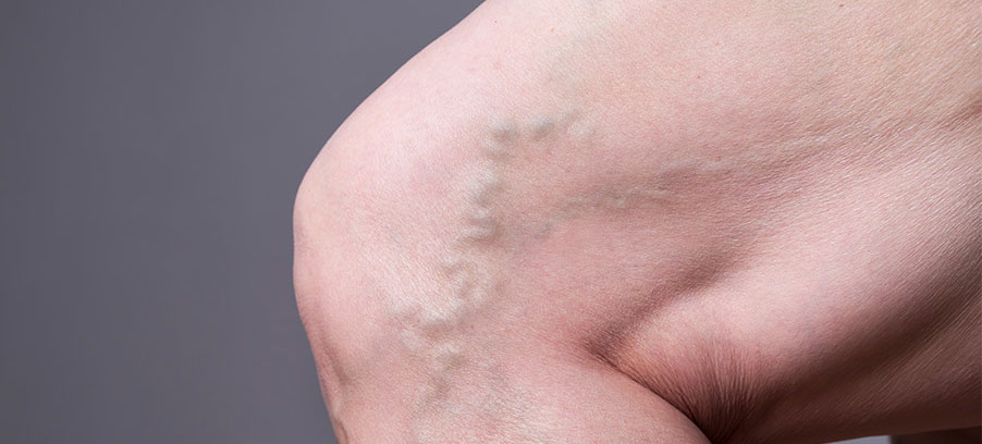 Comment en finir avec les varicosités?