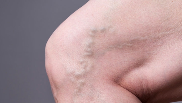 Comment en finir avec les varicosités?